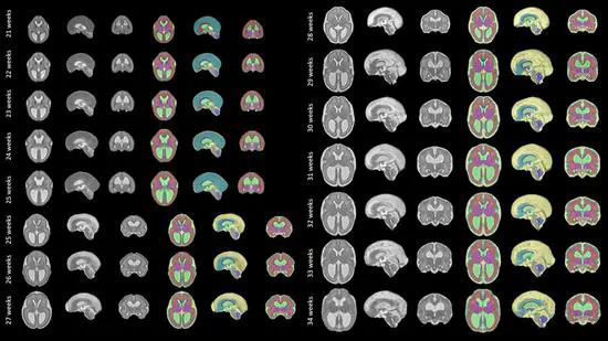 A spatio-temporal atlas of the developing fetal brain with spina bifida aperta