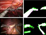 PhD opportunity on "Semi-supervised detection and tracking of instruments for robotic surgery guidance"
