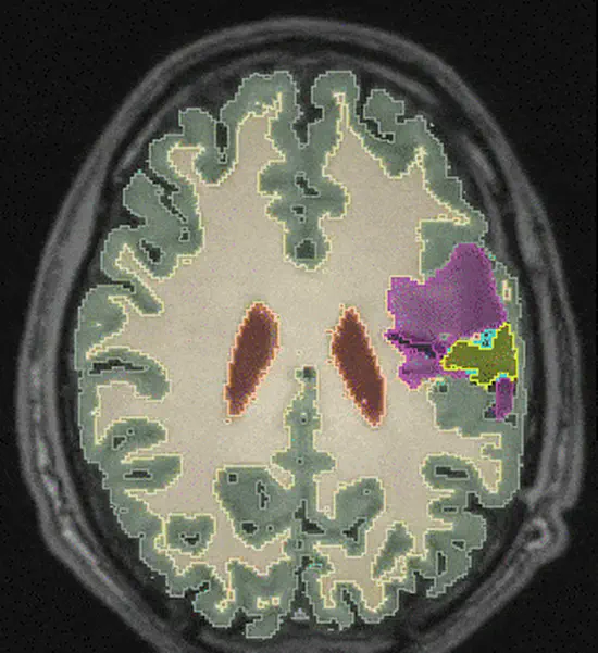 Learning joint Segmentation of Tissues And Brain Lesions (jSTABL) from task-specific hetero-modal domain-shifted datasets