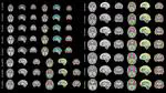 A spatio-temporal atlas of the developing fetal brain with spina bifida aperta