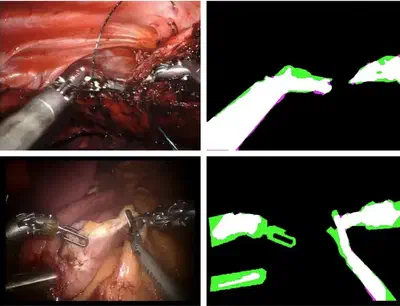 Representative sample images of robotic surgery (left) and state-of-the-art instrument segmentation results (right). True positive (white), true negative (black), false positive (magenta), and false negative (green).