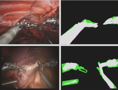 Representative  sample images of robotic surgery (left)  and state-of-the-art instrument segmentation results (right). True positive (white), true negative (black), false positive (magenta), and false negative (green).