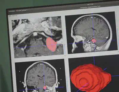 Representative  automated segmentation of a vestibular schwanoma.