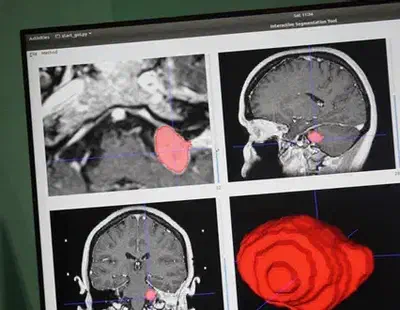 Representative automated segmentation of a vestibular schwanoma.
