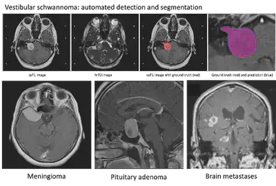 Exemplar cases and task for AI-driven management of brain tumours.