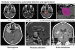 PhD opportunity on "Artificial intelligence-driven management of brain tumours"