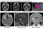 PhD opportunity on "Artificial intelligence-driven management of brain tumours"