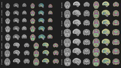 A Spatio-temporal Atlas of the Developing Fetal Brain with Spina Bifida Aperta.