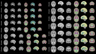 A Spatio-temporal Atlas of the Developing Fetal Brain with Spina Bifida Aperta.