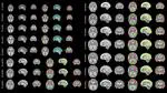 Open-access Spatio-temporal Atlas of the Developing Fetal Brain with Spina Bifida Aperta