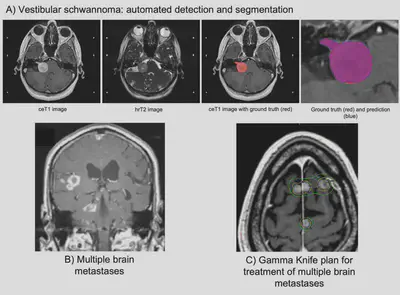 Automated detection and segmentation of brain metastases using MRI for radiosurgery planning.