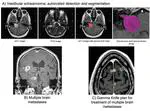 PhD opportunity on "Artificial intelligence-driven radiosurgery planning for brain metastases"