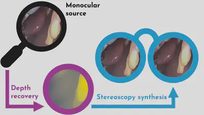 Computational stereovision synthesis from monocular neuroendoscopy.