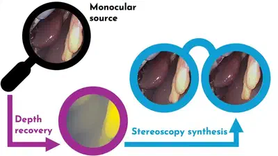 Computational stereovision synthesis from monocular neuroendoscopy.