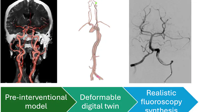 PhD opportunity [October 2025 start] on "Patient-specific CTA-informed in-silico simulation of interventional fluoroscopy: A digital twin for stroke patients"