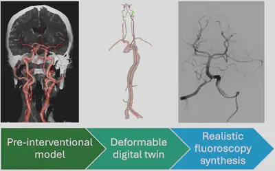 Patient-specific CTA-informed in-silico simulation of interventional fluoroscopy: A digital twin for stroke patients.