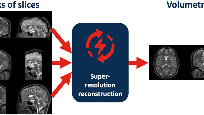 KDC Africa PhD studentship [October 2025 start preferred - no later than June 2026] on "Resource-efficient slice-to-volume MRI super-resolution reconstruction for improved meningioma management in Sub-Saharan Africa"