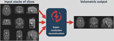 Slice-to-volume MRI super-resolution reconstruction workflow.