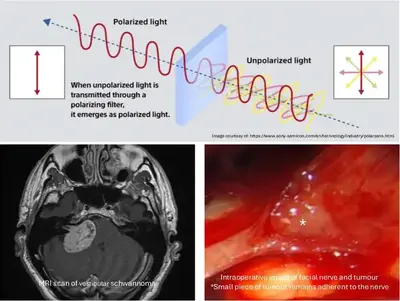Polarimetric imaging for better intra-operative visualisation of cranial nerves.