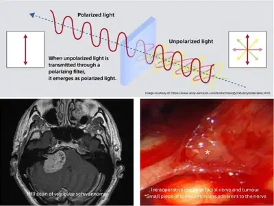 Polarimetric imaging for better intra-operative visualisation of cranial nerves.