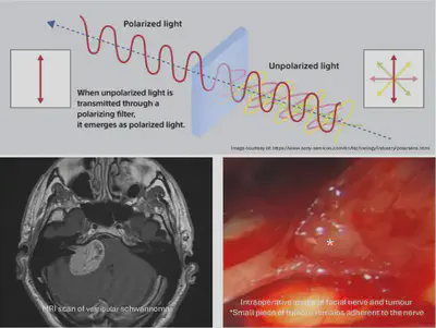 Polarimetric imaging for better intra-operative visualisation of cranial nerves.